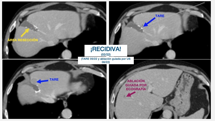 Ablacion estereoataxia lesiones hepaticas 04