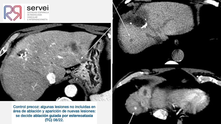 Ablacion estereoataxia lesiones hepaticas 05