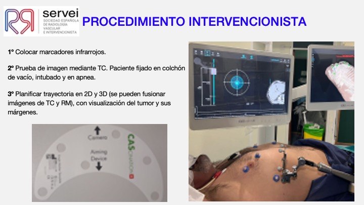 Ablacion estereoataxia lesiones hepaticas 06
