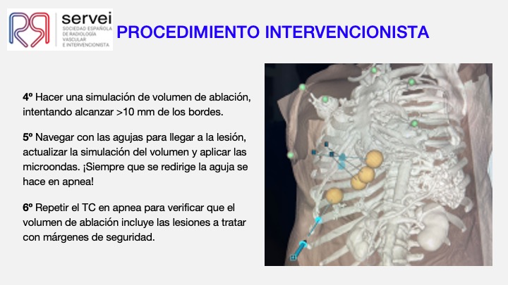 Ablacion estereoataxia lesiones hepaticas 07