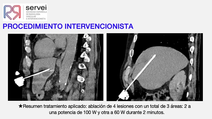 Ablacion estereoataxia lesiones hepaticas 09