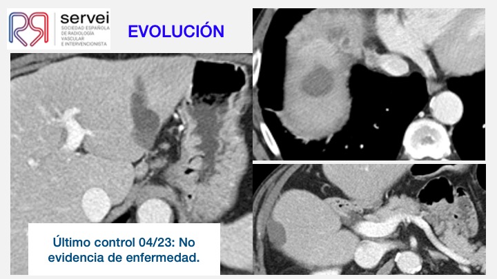 Ablacion estereoataxia lesiones hepaticas 10