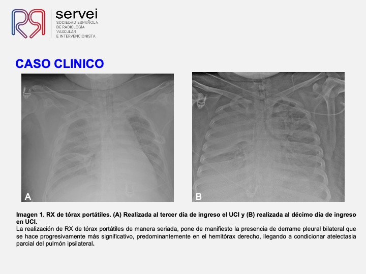 Pseudoaneurismas subclavia stent 03