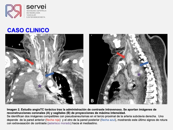 Pseudoaneurismas subclavia stent 05