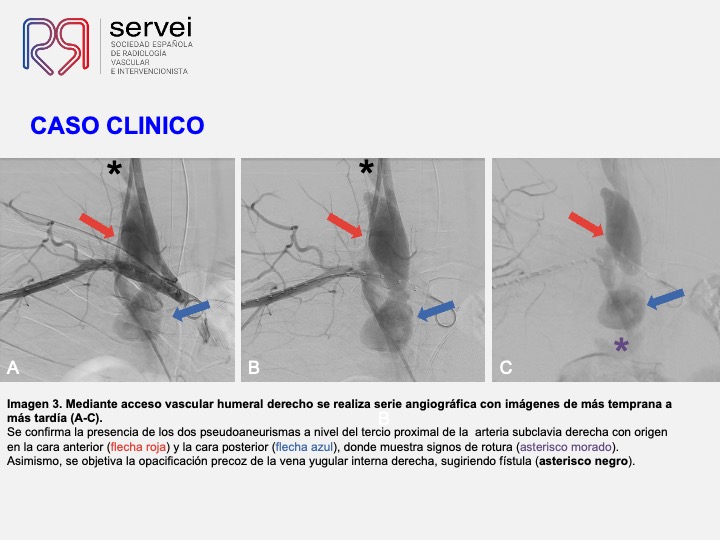 Pseudoaneurismas subclavia stent 07