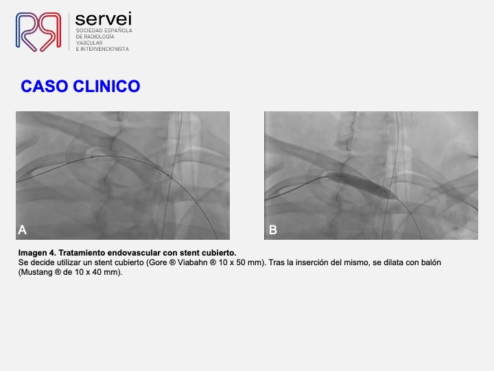 Pseudoaneurismas subclavia stent 08+