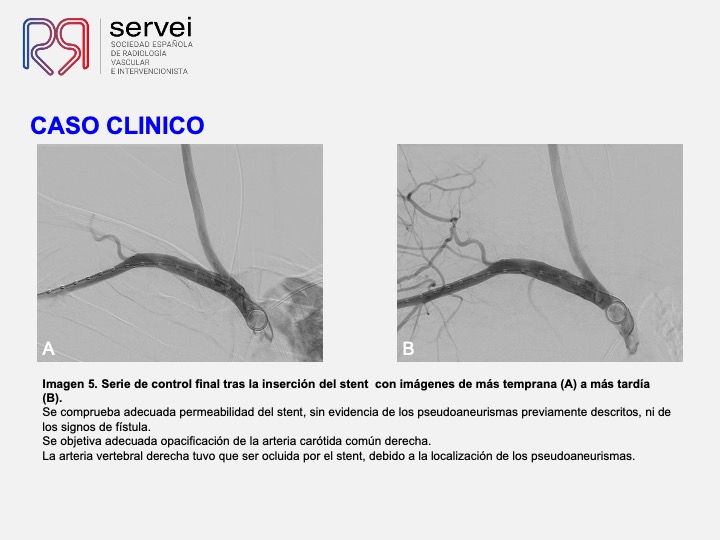 Pseudoaneurismas subclavia stent 09