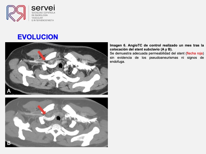 Pseudoaneurismas subclavia stent 10