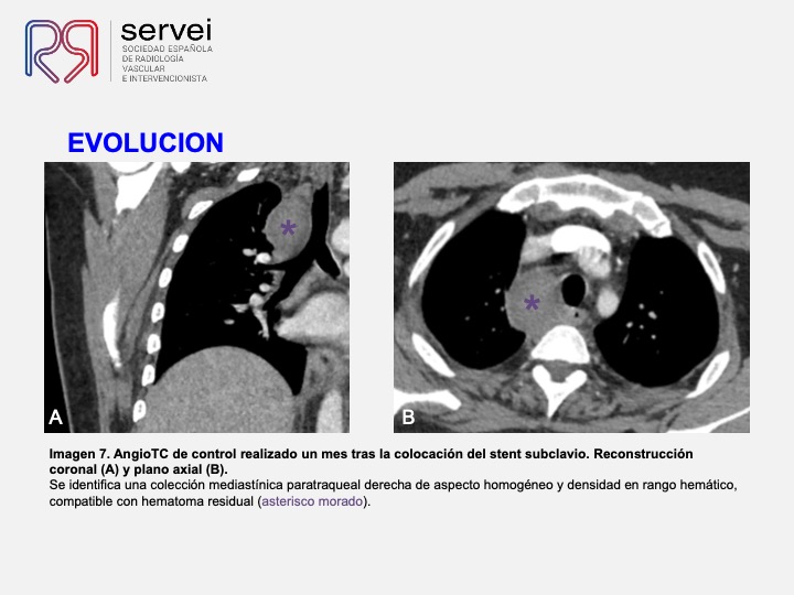 Pseudoaneurismas subclavia stent 11