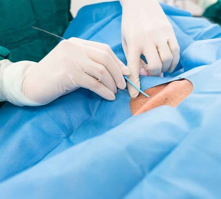 Tratamiento-embolizacion-hiperplasia-benigna-de-prostata
