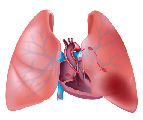Tromboembolismo-pulmonar
