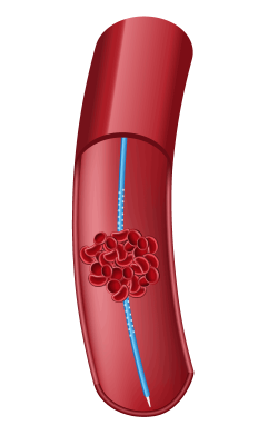 Trombolisis-farmaco-mecanica