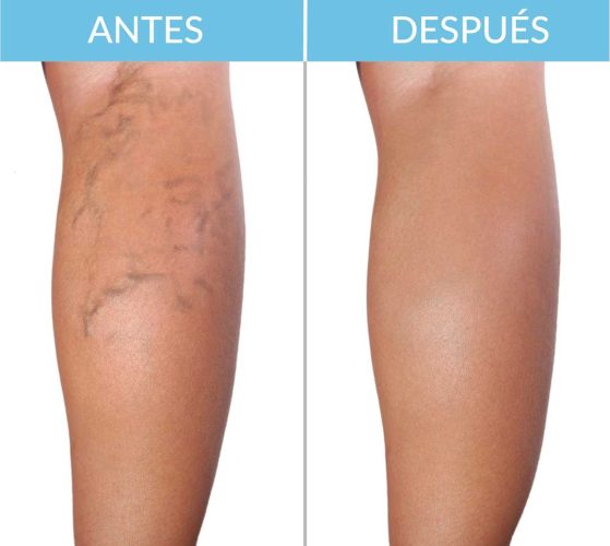 Varices-piernas_antes-y-despues